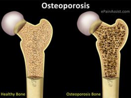 Identifican nuevos genes asociados al desarrollo de la osteoporosis