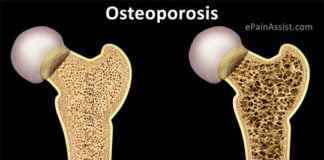 Identifican nuevos genes asociados al desarrollo de la osteoporosis