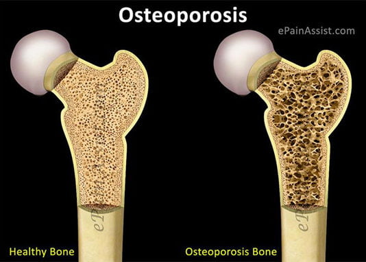 Identifican nuevos genes asociados al desarrollo de la osteoporosis