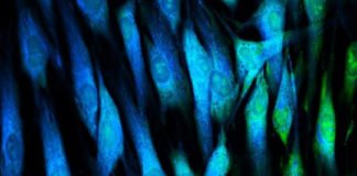 Revolucionaria técnica para tratar el glioblastoma, el cáncer cerebral