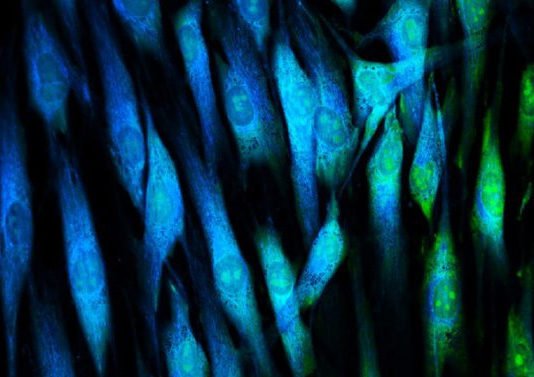 Revolucionaria técnica para tratar el glioblastoma, el cáncer cerebral