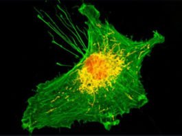 Un estudio señala que, con diabetes y niveles altos de azúcar en sangre, hay menos probabilidad de cáncer cerebral Cáncer