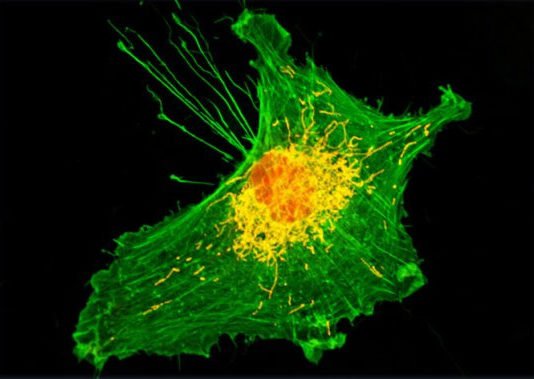 Un estudio señala que, con diabetes y niveles altos de azúcar en sangre, hay menos probabilidad de cáncer cerebral Cáncer