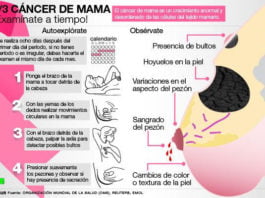 Cáncer de mama ER+: Nuevo biomarcador importante, que predice el resultado de la terapia y es un posible objetivo farmacológico Cáncer de mama exploración