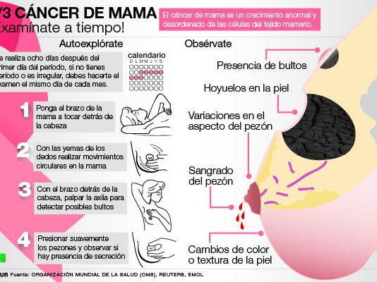 Cáncer de mama ER+: Nuevo biomarcador importante, que predice el resultado de la terapia y es un posible objetivo farmacológico Cáncer de mama exploración