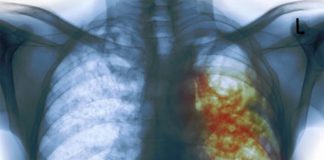 Investigadores descubren un nuevo mecanismo de resistencia antibiótica en la tuberculosis y la lepra