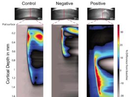 Investigadores dan un paso clave para detener la migraña en su inicio Migraña