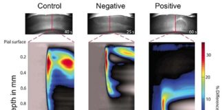 Investigadores dan un paso clave para detener la migraña en su inicio Migraña