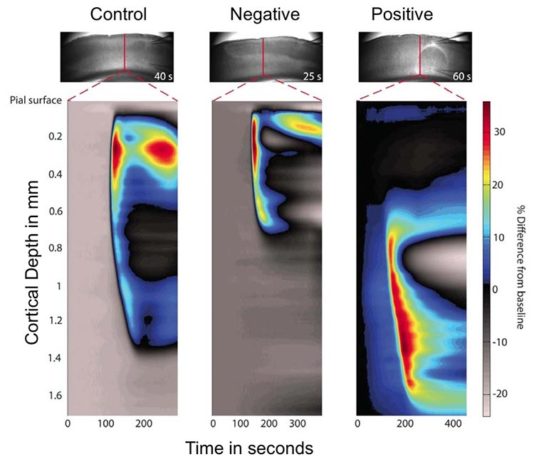 Investigadores dan un paso clave para detener la migraña en su inicio Migraña