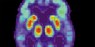 Fármaco experimental revierte la pérdida sináptica en modelos de ratón con Alzheimer Alzheimer