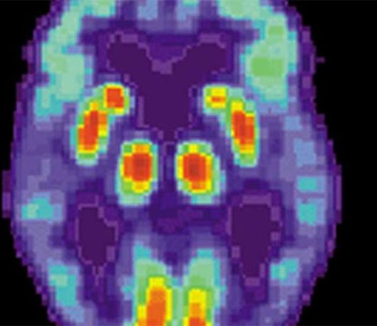 Un medicamento para tratar enfermedades hepáticas podría ayudar a restaurar las células dañadas por el Alzheimer Alzheimer