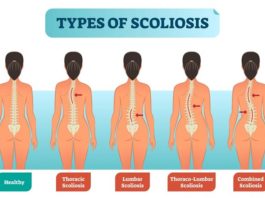 Asociado el riesgo de padecer escoliosis con una deficiencia en la absorción de manganeso Escoliosis