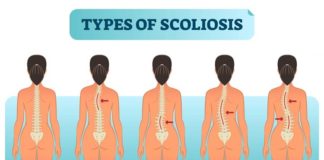 Asociado el riesgo de padecer escoliosis con una deficiencia en la absorción de manganeso Escoliosis