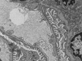 Nueva investigación sobre el fallo renal alerta del uso de ciertos medicamentos Filtración en el riñón