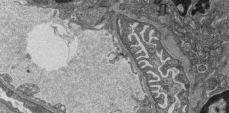 Nueva investigación sobre el fallo renal alerta del uso de ciertos medicamentos Filtración en el riñón