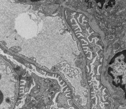 Nueva investigación sobre el fallo renal alerta del uso de ciertos medicamentos Filtración en el riñón