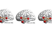 Un mapa neuronal muestra cómo se desarrolla la afasia progresiva primaria Regiones afectadas por la afasia