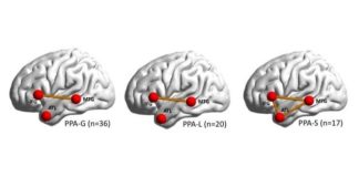 Un mapa neuronal muestra cómo se desarrolla la afasia progresiva primaria Regiones afectadas por la afasia