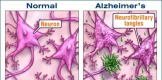 El cáncer de piel utiliza la proteína del Alzheimer para sabotear las defensas inmunitarias del cerebro Alzheimer: las placas amiloides