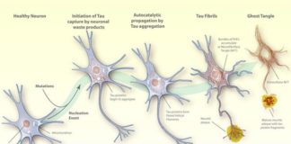 Nuevo estudio sobre las proteínas tau del cerebro podría ayudar a abordar la demencia Alzheimer: proteínas tau
