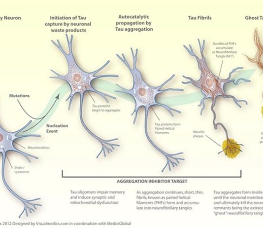 Nuevo estudio sobre las proteínas tau del cerebro podría ayudar a abordar la demencia Alzheimer: proteínas tau