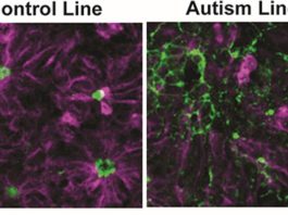 Las células nerviosas de las personas autistas difieren antes del nacimiento Formación de rosetas neurales en líneas de células madre de control versus autismo. Crédito: Biological Psychiatry
