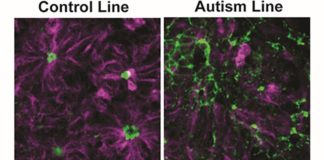 Las células nerviosas de las personas autistas difieren antes del nacimiento Formación de rosetas neurales en líneas de células madre de control versus autismo. Crédito: Biological Psychiatry