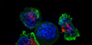 Un nuevo tipo de células T podría desempeñar un papel en la esclerosis múltiple Células T rodean a las células cancerosas