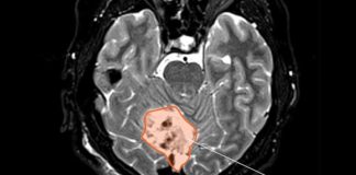 Encuentran una manera potencial de que el cáncer cerebral infantil sea más tratable Meduloblastoma (cáncer cerebral infantil)