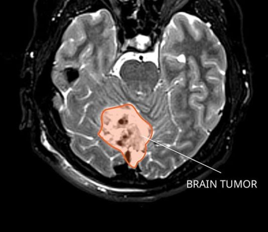 Encuentran una manera potencial de que el cáncer cerebral infantil sea más tratable Meduloblastoma (cáncer cerebral infantil)