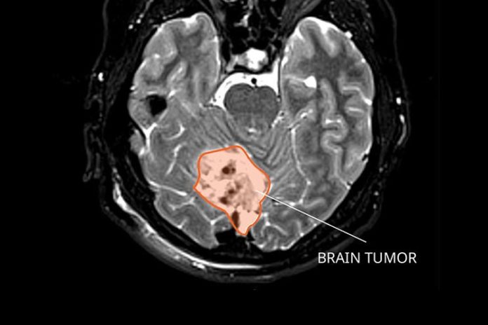 Meduloblastoma (cáncer cerebral infantil)