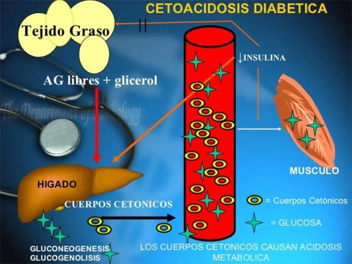 Cetoacidosis diabética