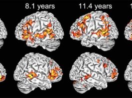 Los niños usan ambos hemisferios cerebrales para comprender el lenguaje, a diferencia de los adultos Ejemplos de mapas de activación cerebral individuales en cada uno de los grupos de edad en respuesta al lenguaje