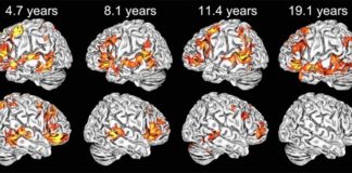Los niños usan ambos hemisferios cerebrales para comprender el lenguaje, a diferencia de los adultos Ejemplos de mapas de activación cerebral individuales en cada uno de los grupos de edad en respuesta al lenguaje