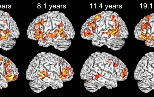 Los niños usan ambos hemisferios cerebrales para comprender el lenguaje, a diferencia de los adultos Ejemplos de mapas de activación cerebral individuales en cada uno de los grupos de edad en respuesta al lenguaje