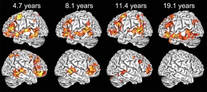 Ejemplos de mapas de activación cerebral individuales en cada uno de los grupos de edad en respuesta al lenguaje Ejemplos de mapas de activación cerebral individuales en cada uno de los grupos de edad en respuesta al lenguaje