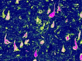 Descubren una forma genética rara de demencia: Tauopatía vacuolar, relacionada con el Alzheimer Ovillos neurofibrilares anormales (NFT), una acumulación de proteína tau en partes del cerebro, ayudaron a Edward Lee a descubrir esta nueva forma de demencia: la tauopatía vacuolar