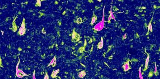 Descubren una forma genética rara de demencia: Tauopatía vacuolar, relacionada con el Alzheimer Ovillos neurofibrilares anormales (NFT), una acumulación de proteína tau en partes del cerebro, ayudaron a Edward Lee a descubrir esta nueva forma de demencia: la tauopatía vacuolar