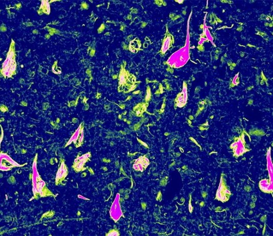 Descubren una forma genética rara de demencia: Tauopatía vacuolar, relacionada con el Alzheimer Ovillos neurofibrilares anormales (NFT), una acumulación de proteína tau en partes del cerebro, ayudaron a Edward Lee a descubrir esta nueva forma de demencia: la tauopatía vacuolar