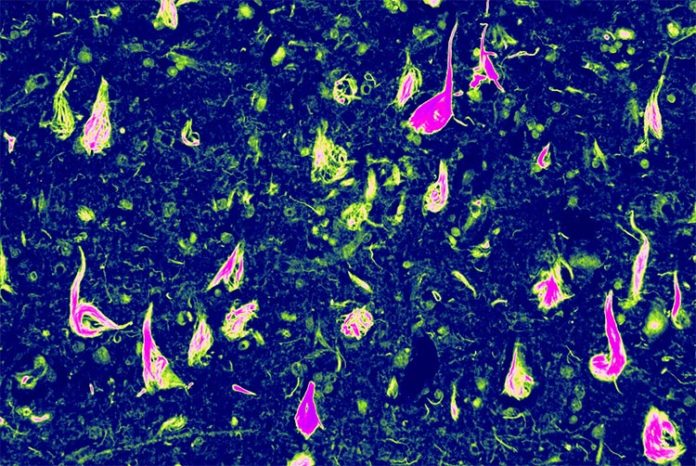 Ovillos neurofibrilares anormales (NFT), una acumulación de proteína tau en partes del cerebro, ayudaron a Edward Lee a descubrir esta nueva forma de demencia: la tauopatía vacuolar