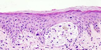 Doblan la eficacia de una vacuna para prevenir la recurrencia del cáncer de piel Cáncer de piel: Melanoma en biopsia de piel con tinción