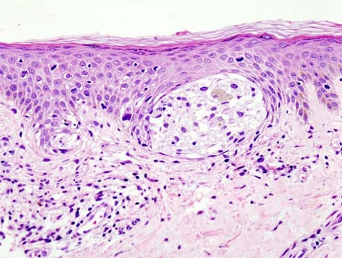Cáncer de piel: Melanoma en biopsia de piel con tinción Cáncer de piel: Melanoma en biopsia de piel con tinción
