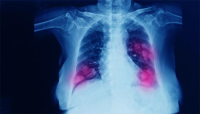 Metástasis pulmonar