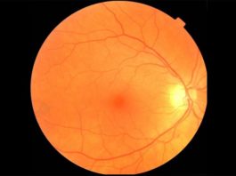 Un examen de ojo combinado con una IA podría diagnosticar Parkinson mucho antes Un ejemplo de imagen de fondo de ojo que puede ser usada para diagnosticar Parkinson