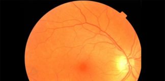 Un examen de ojo combinado con una IA podría diagnosticar Parkinson mucho antes Un ejemplo de imagen de fondo de ojo que puede ser usada para diagnosticar Parkinson