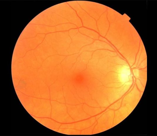 Un examen de ojo combinado con una IA podría diagnosticar Parkinson mucho antes Un ejemplo de imagen de fondo de ojo que puede ser usada para diagnosticar Parkinson