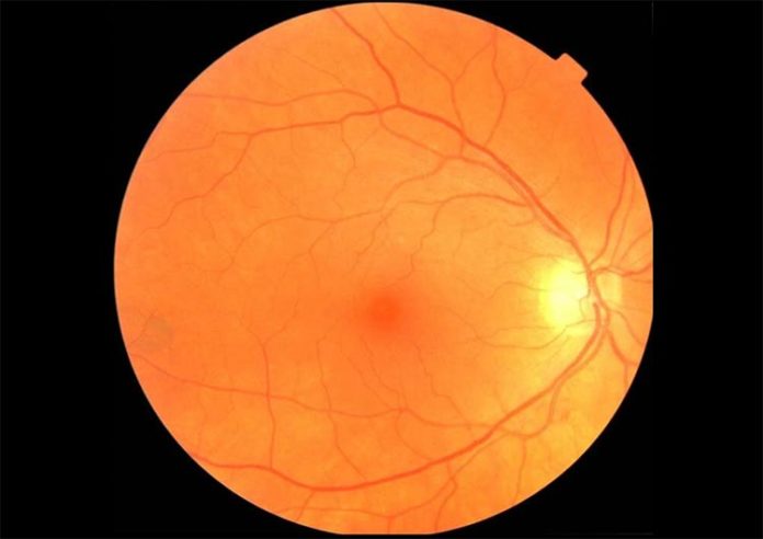 Un ejemplo de imagen de fondo de ojo que puede ser usada para diagnosticar Parkinson