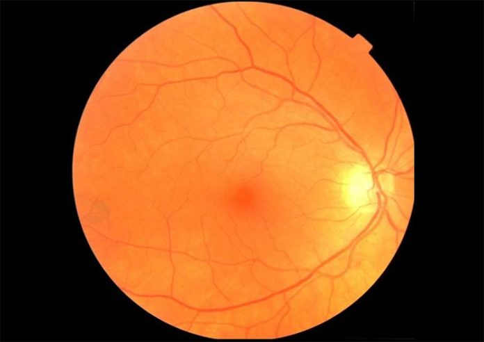 Un ejemplo de imagen de fondo de ojo que puede ser usada para diagnosticar Parkinson Un ejemplo de imagen de fondo de ojo que puede ser usada para diagnosticar Parkinson