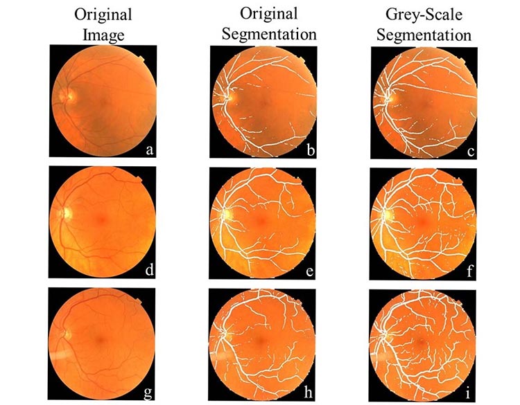 Comparación de la segmentación del vaso a partir de la imagen de entrada para diagnosticar Parkinson
