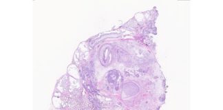 Los teratomas (tumores monstruosos) serían modelo del desarrollo humano Imagen de histología de un teratoma